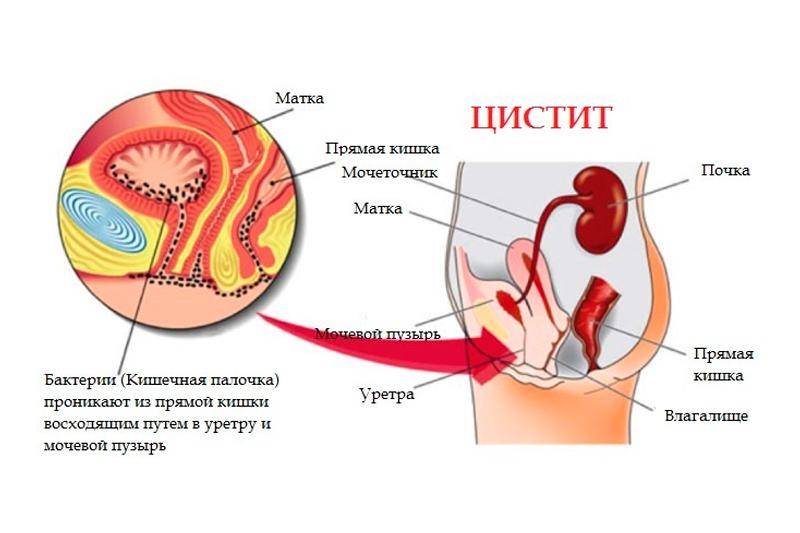 Кишечная палочка в мочевом пузыре у женщин