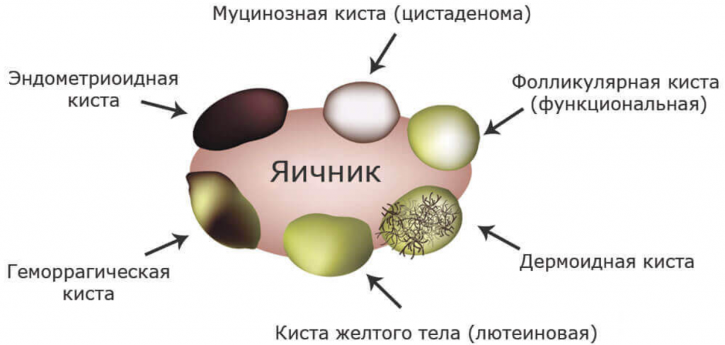 Киста на яичнике причины возникновения у женщин