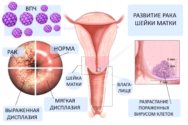 Кольпоскопия шейки матки при эрозии