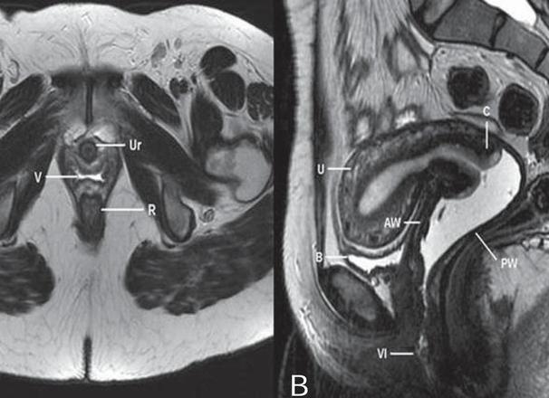 Мрт матки и яичников Мрт матки и яичников