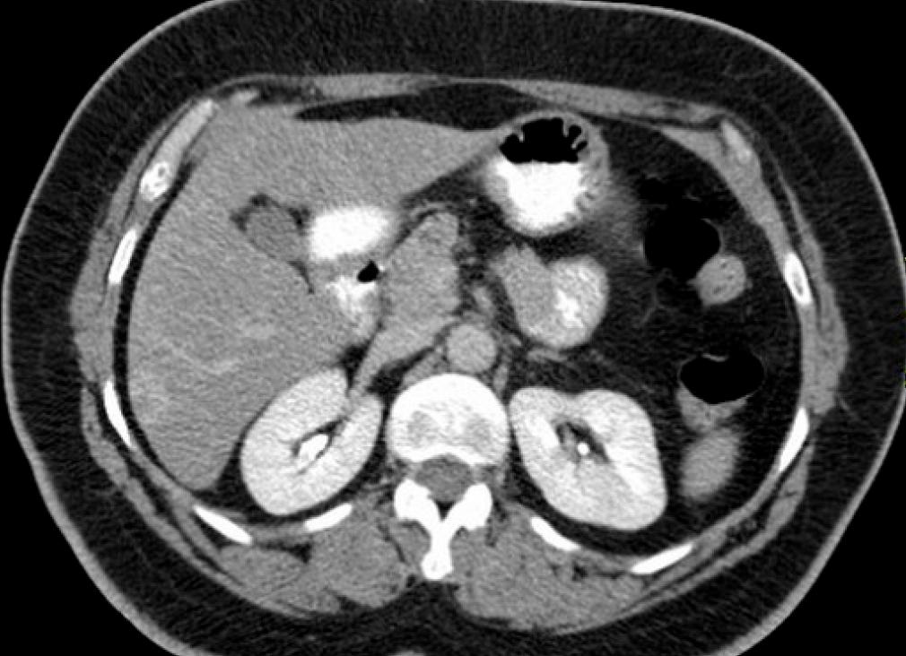 Мрт гемангиома печени