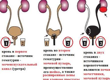 Микрогематурия у мужчин