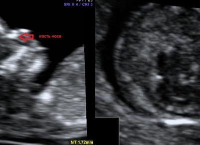 Маленький нос у плода на узи 12 недель