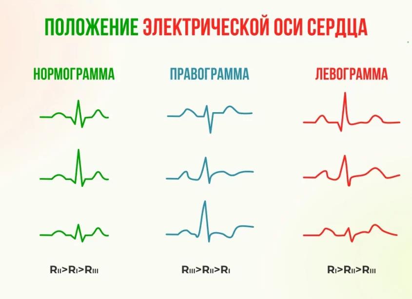 Левограмма на экг Левограмма на экг