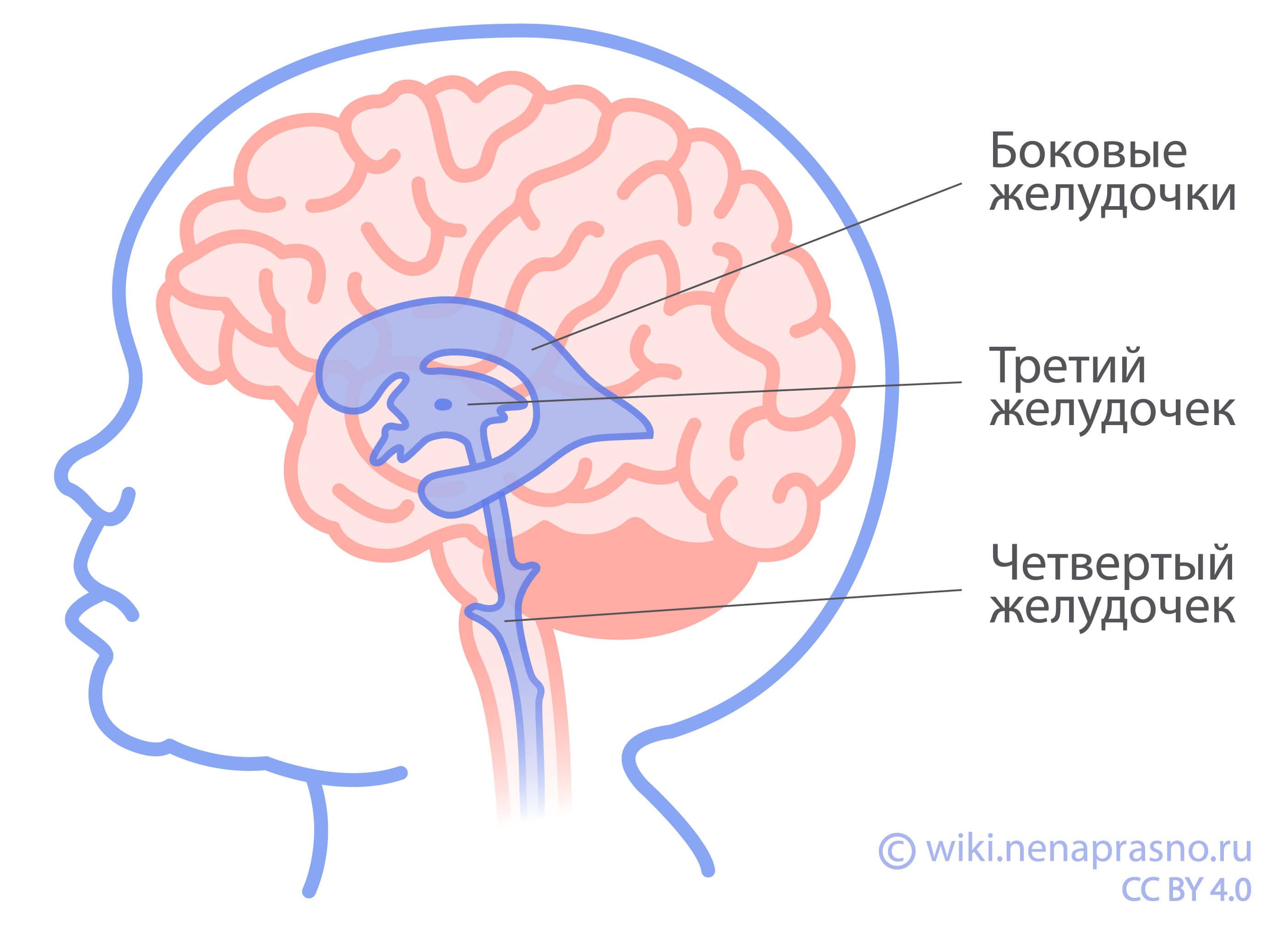 Киста сосудистого сплетения головного мозга у грудничка