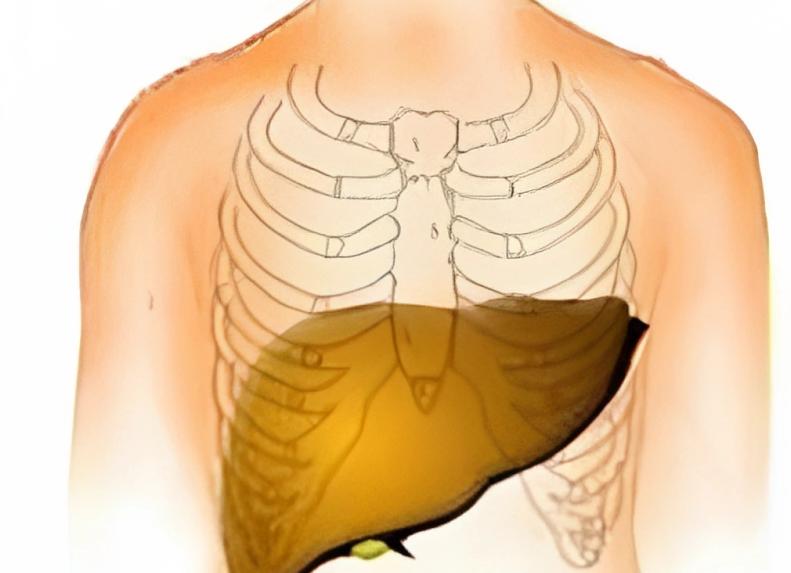 Гепатомегалия это приговор Гепатомегалия это приговор