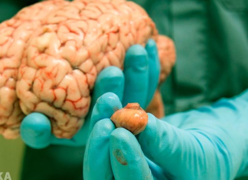 Фото опухоль мозга