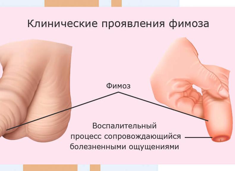 Фимоз у взрослых