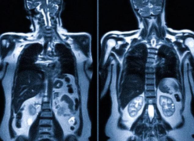 Есть ли при мрт облучение