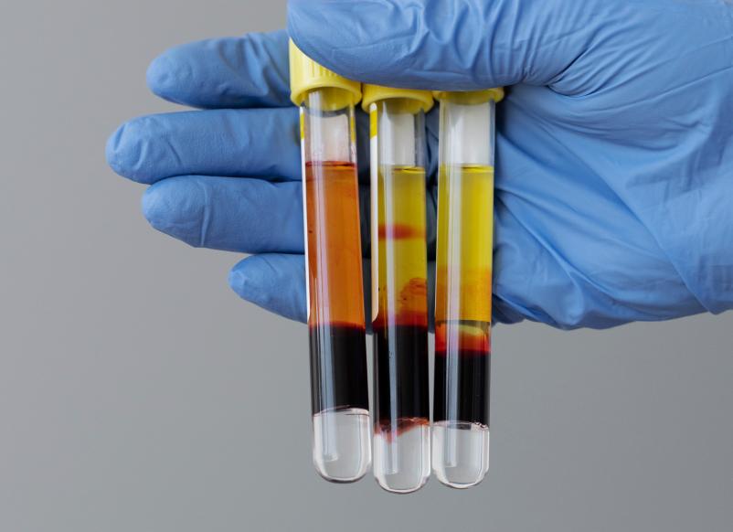 Что такое гематокрит и о чем говорит его понижение Что такое гематокрит и о чем говорит его понижение