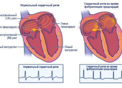 Что такое фибрилляция сердца
