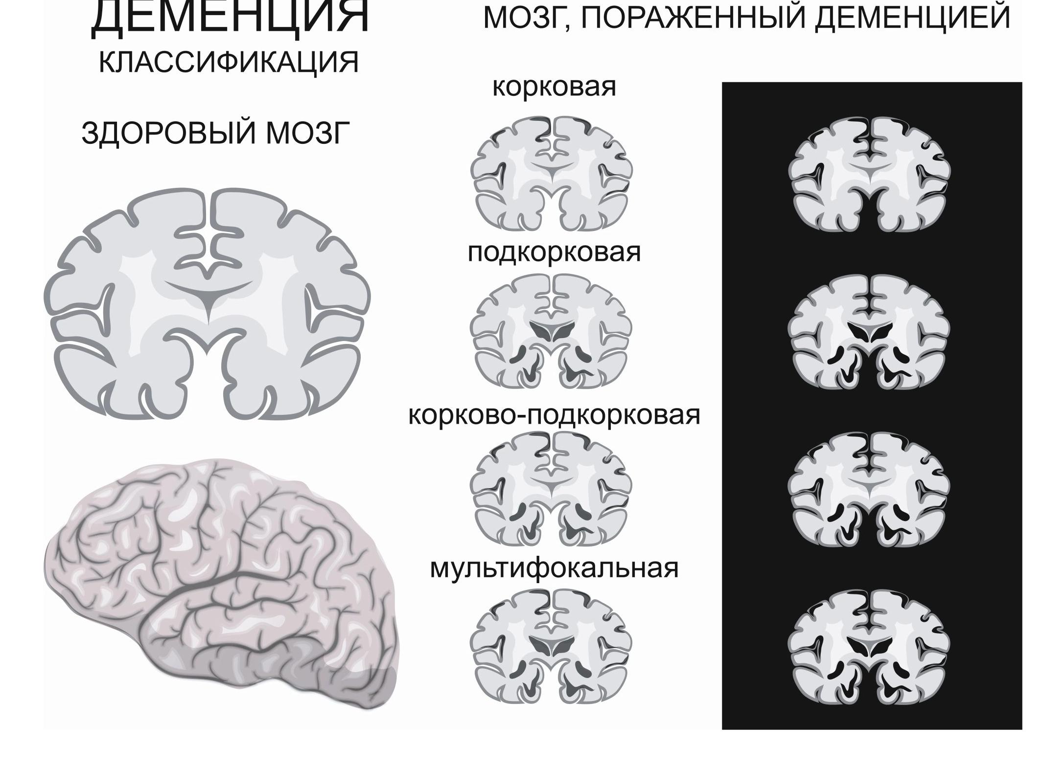 Что такое деменция головного мозга