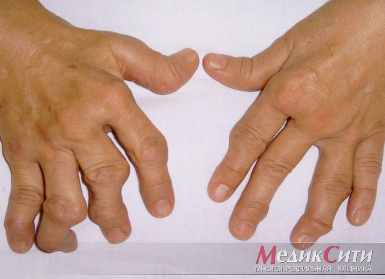 Что показывает ревматоидный фактор Что показывает ревматоидный фактор