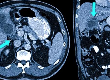 Чем отличается мрт от кт брюшной полости Чем отличается мрт от кт брюшной полости