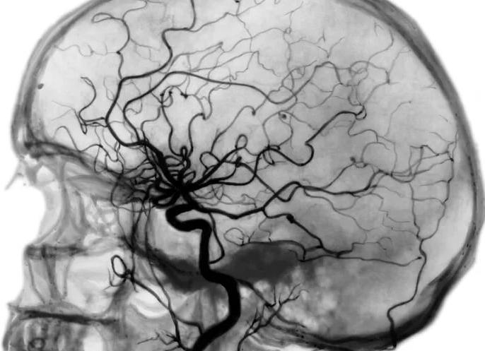 Церебральная ангиография сосудов головного мозга