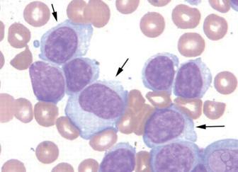 Атипичные лимфоциты в анализе крови у взрослых
