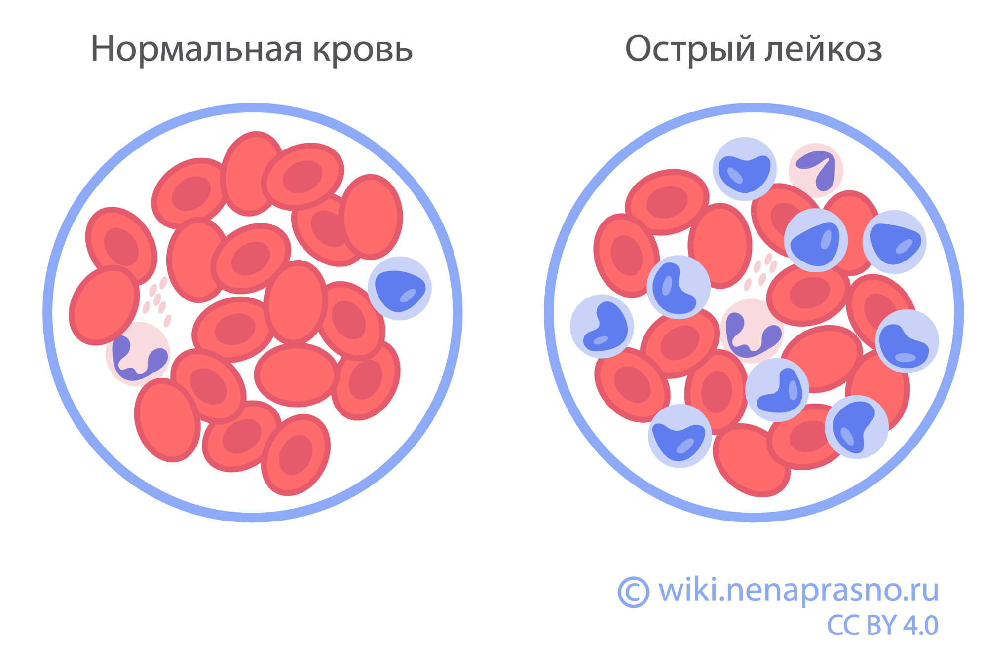 Лимфолейкоз что это такое прогноз