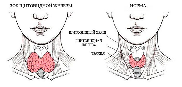 Маленькая щитовидная железа