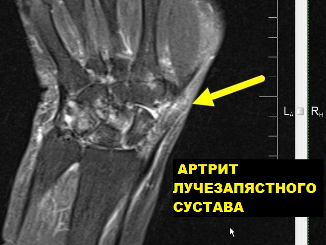 Мрт лучезапястного сустава и кисти руки