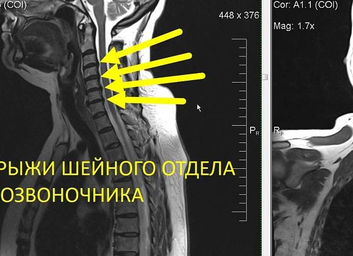 Мрт всего позвоночника