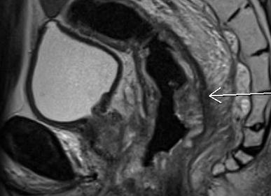 Мрт прямой кишки подготовка