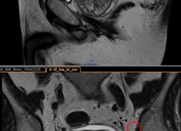 Мрт предстательной железы с контрастированием что показывает