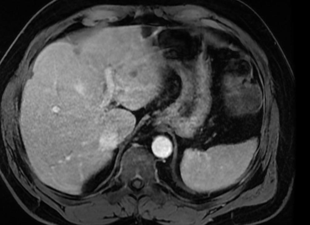 Мрт печени с контрастом Мрт печени с контрастом
