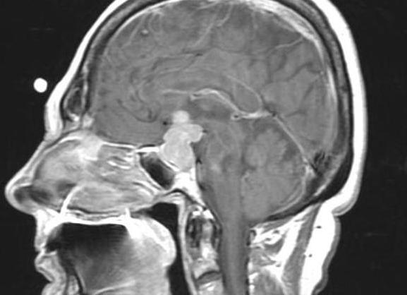 Мрт гипофиза что показывает при повышенном пролактине