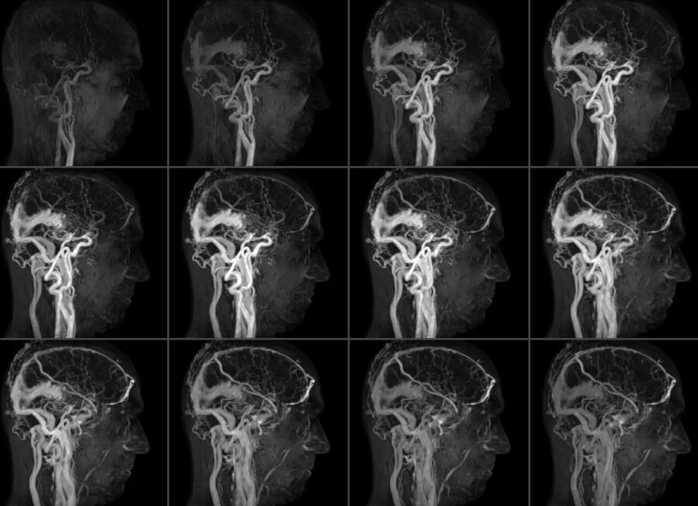 Мра сосудов головного мозга Мра сосудов головного мозга
