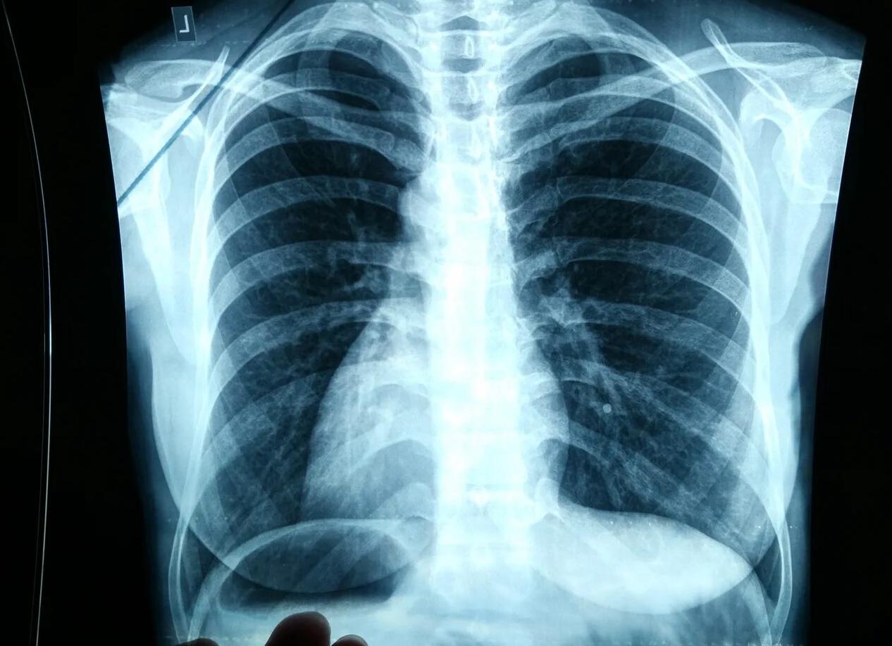 Можно ли делать флюорографию 2 раза в год