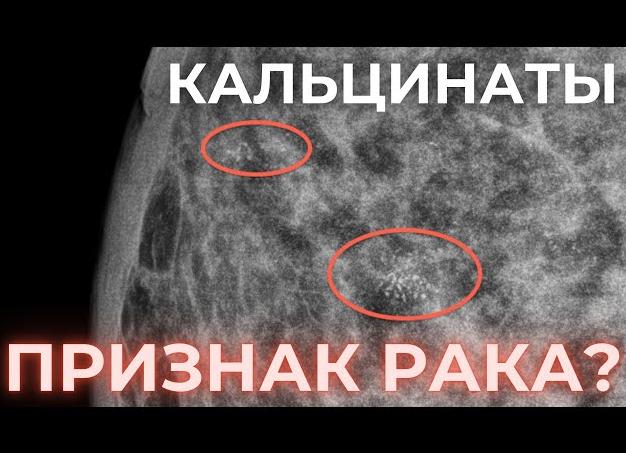Микрокальцинаты в молочной железе что это