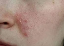 Лабораторная диагностика демодекс Лабораторная диагностика демодекс