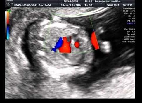 Когда видно на узи сердцебиение плода