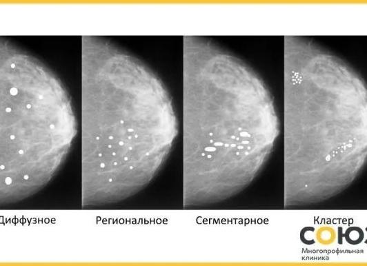 Кальцинаты в молочной железе что это такое
