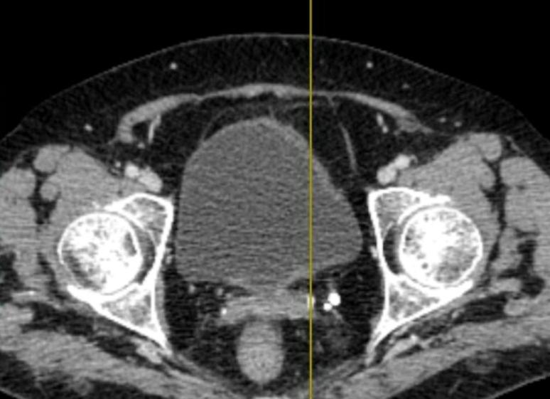 Инволютивные изменения матки