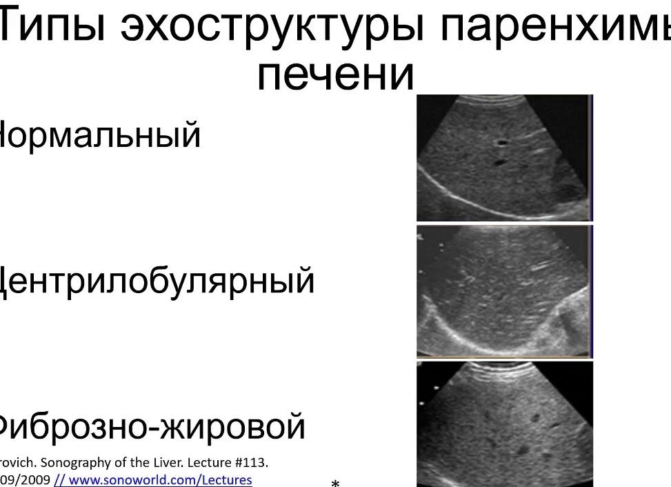 Эхоструктура печени диффузно неоднородная