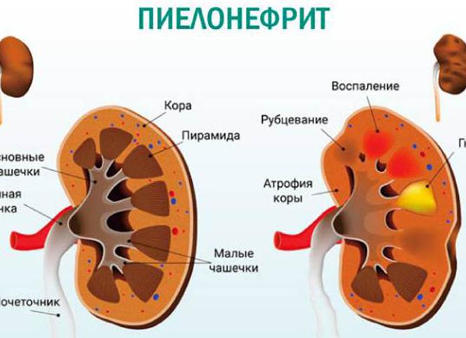 Что такое пиелонефрит у детей