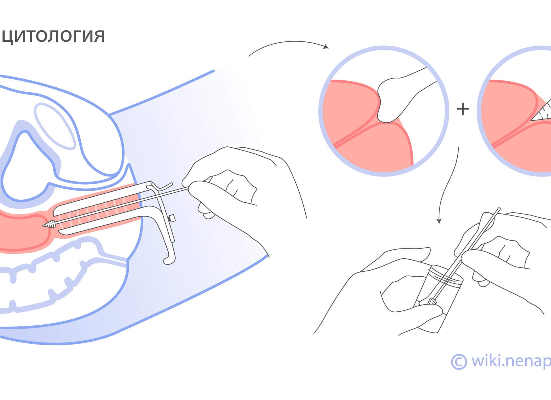 Что такое онкоцитология