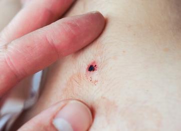 Что будет если родинка оторвется Что будет если родинка оторвется