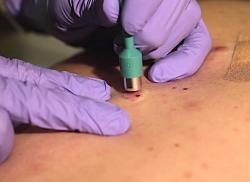 Биопсия кожи с гистологическим исследованием