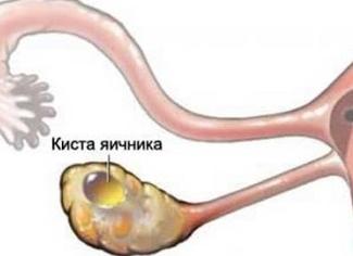 Аваскулярное при цдк что это значит