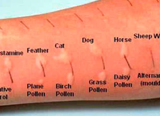 Анализ на аллергию