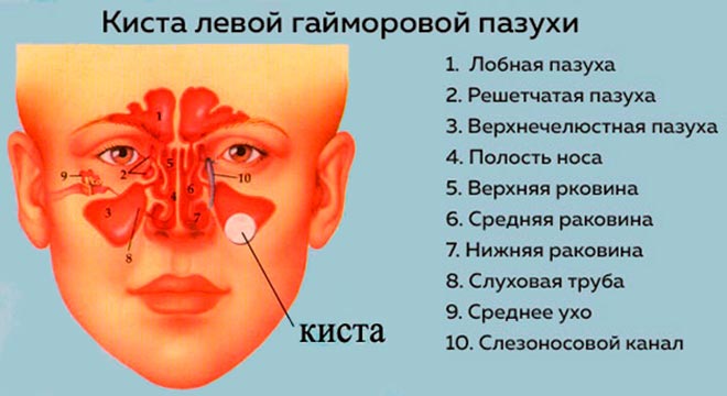 Киста в верхнечелюстной пазухе справа
