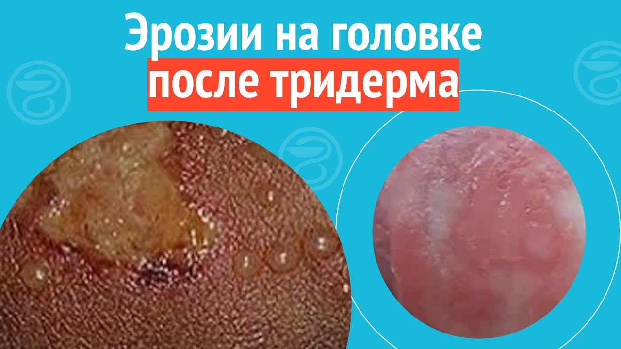 Крем тридерм баланопостит