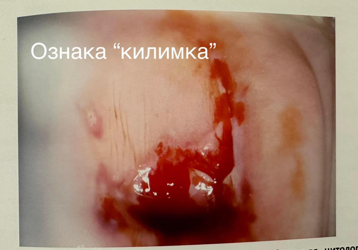 Кровь при эрозии шейки матки