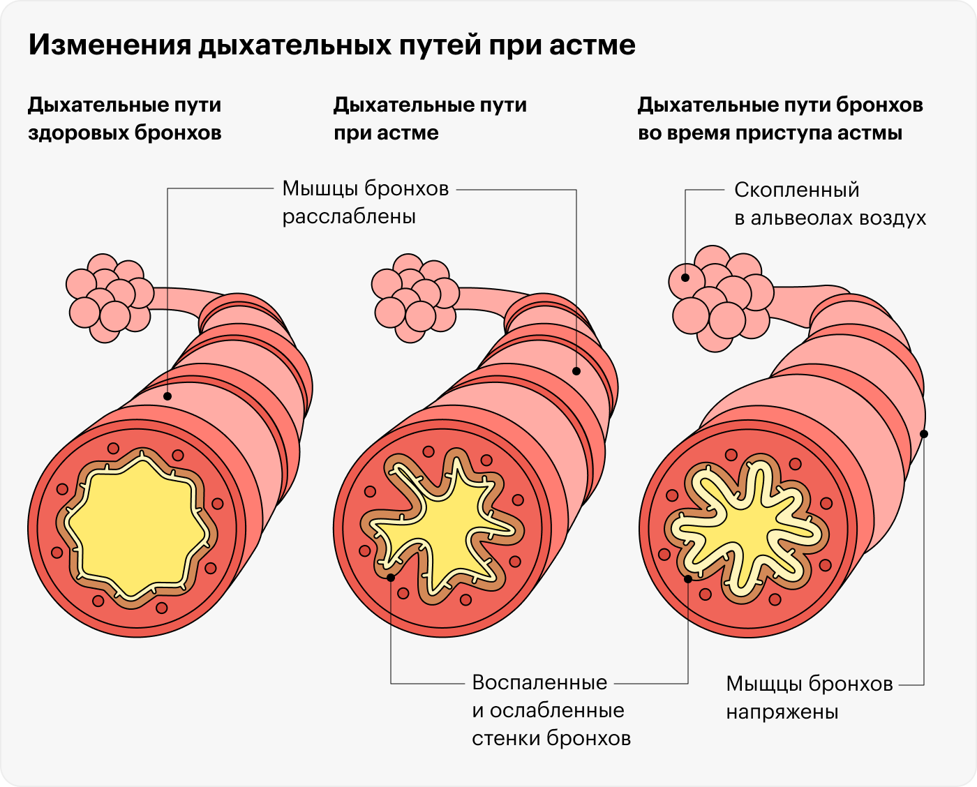 Можно ли делать флюорографию с кашлем