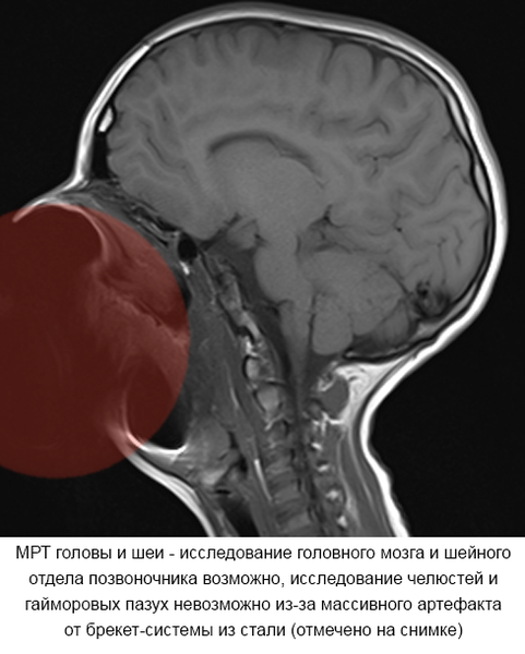 Можно ли делать мрт если есть штифт в зубе