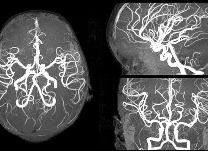 Мрт сосудов головного мозга с контрастом