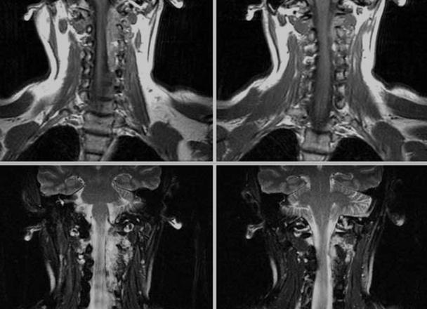 Мрт шеи мягких тканей что показывает