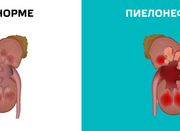 Может ли при пиелонефрите быть хороший анализ мочи